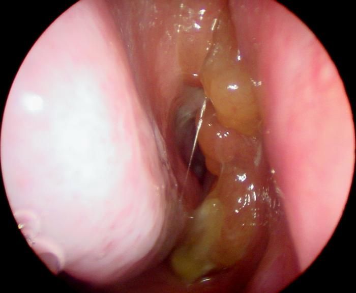 Green Lumps Throat 117